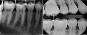 About Your Teeth Xrays Archives - About Your Teeth