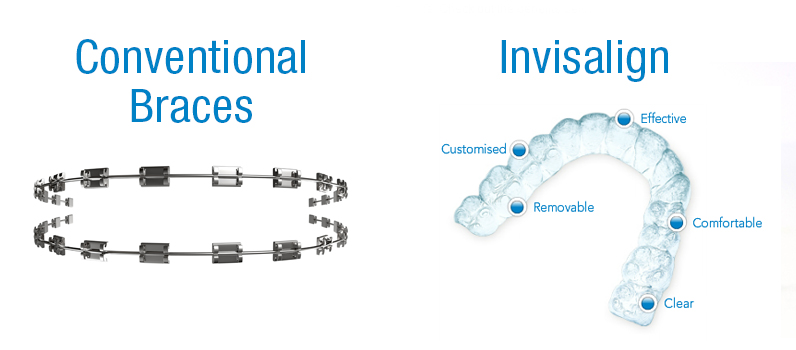 Invisalign